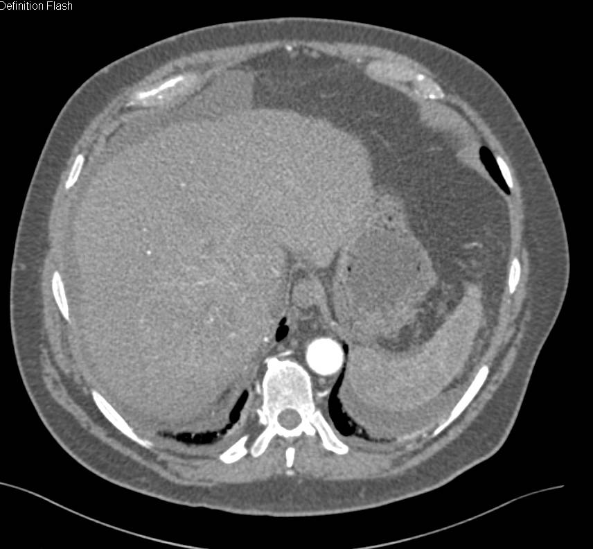 Hepatocellular Carcinoma (Hepatoma) in a Cirrhotic Liver - CTisus CT Scan