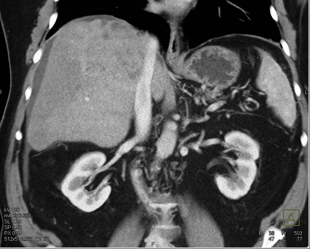 Hepatocellular Carcinoma (Hepatoma) with Neovascularity Invades the Portal Vein - CTisus CT Scan