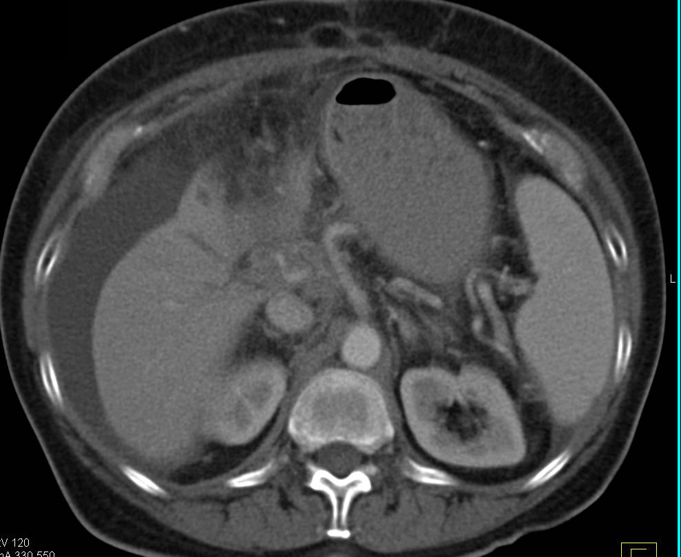 Cirrhosis with Ascites - CTisus CT Scan