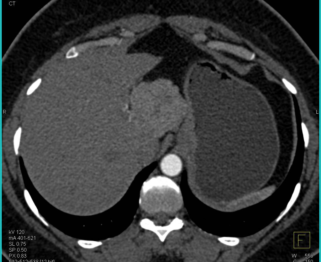 Unusual Appearance of Focal Nodular Hyperplasia of the Liver - CTisus CT Scan