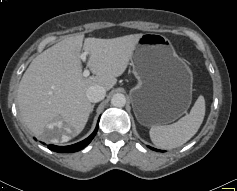 Hepatic Hemangiomas - CTisus CT Scan