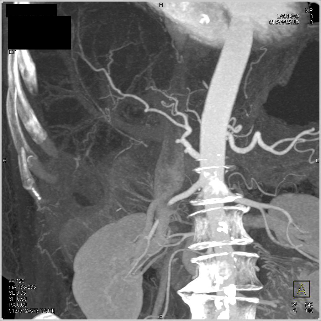 Hepatic Abscess Following Whipple Procedure - CTisus CT Scan