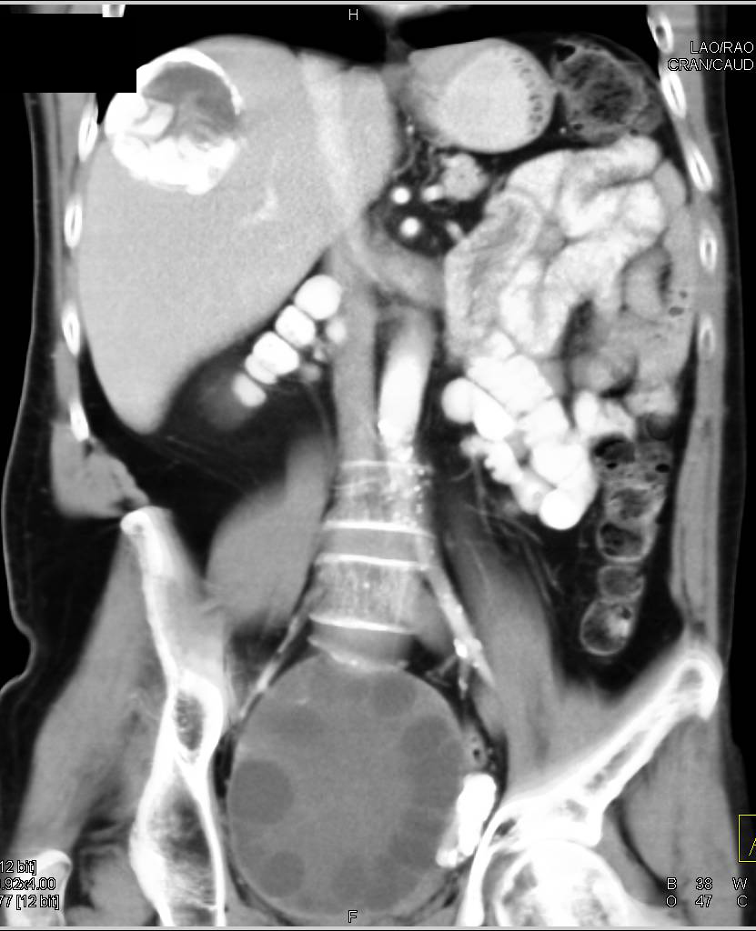 Hydatid Cysts Disease with Cystic Hydatid Lesion Also Present in Pelvis - CTisus CT Scan