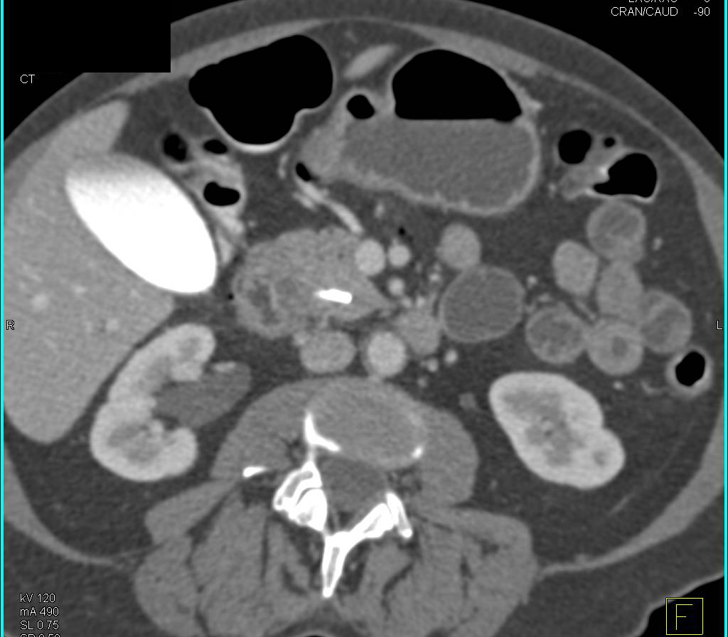 Post Endoscopic Retrograde Cholangiopancreatography (ERCP) With Contrast in Common Bile Duct and Gallbladder - CTisus CT Scan