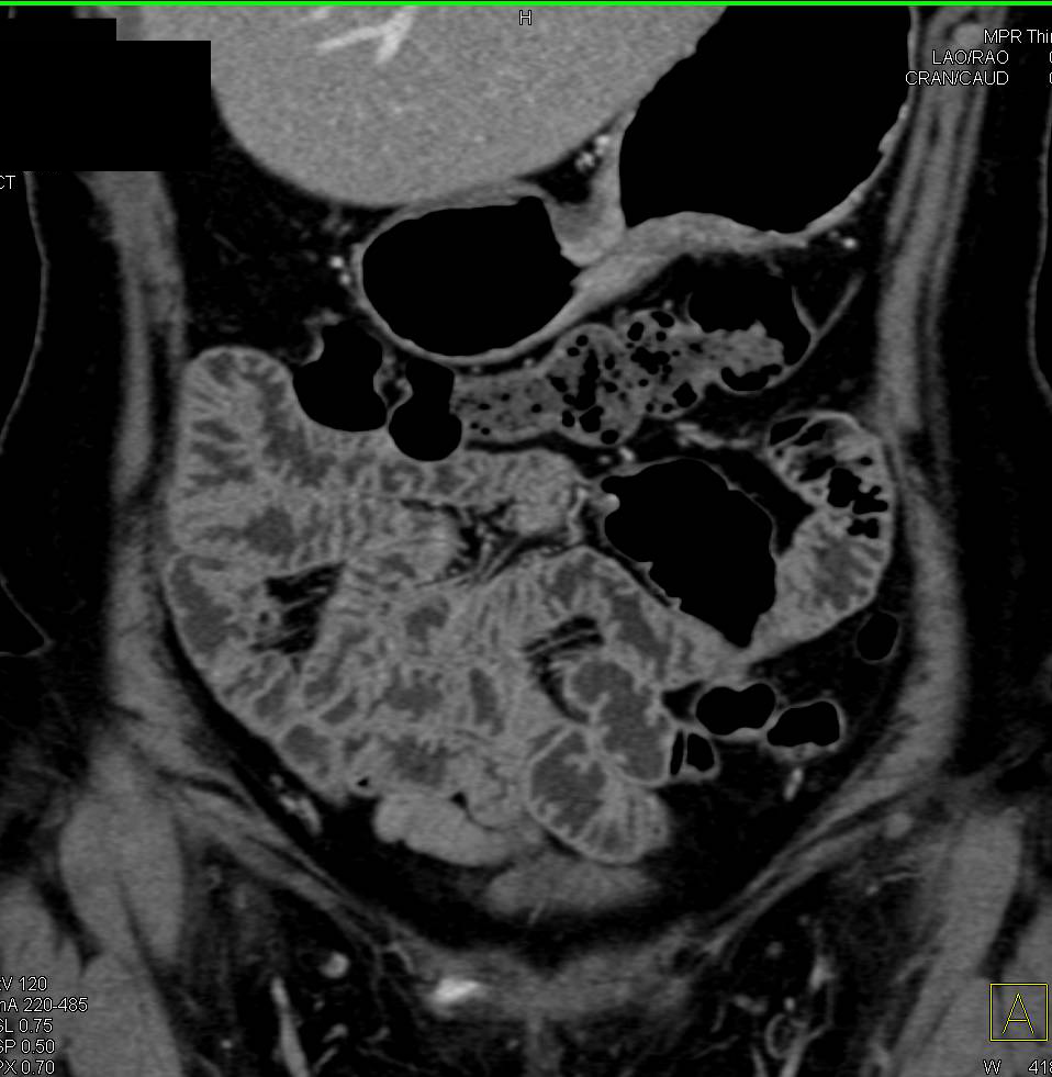 Hepatocellular Carcinoma (Hepatoma) - CTisus CT Scan