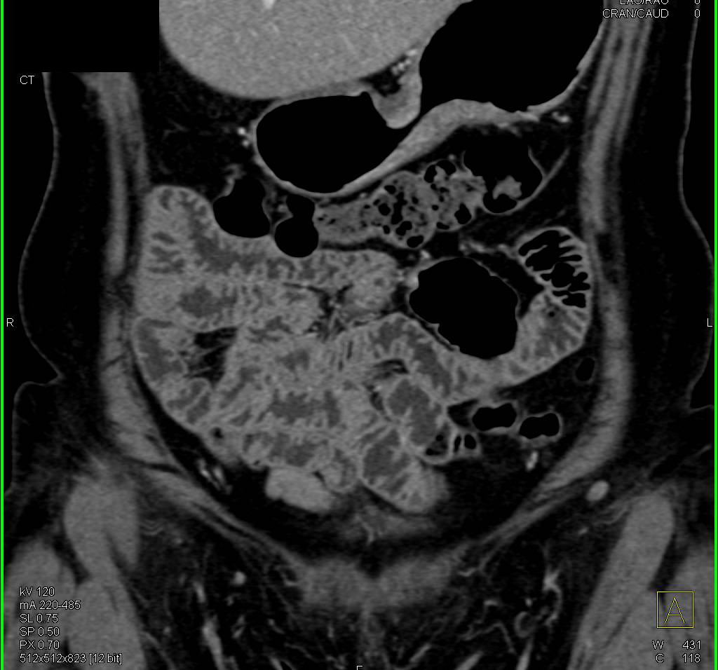 Mesenchymal Tumor off the Liver - CTisus CT Scan