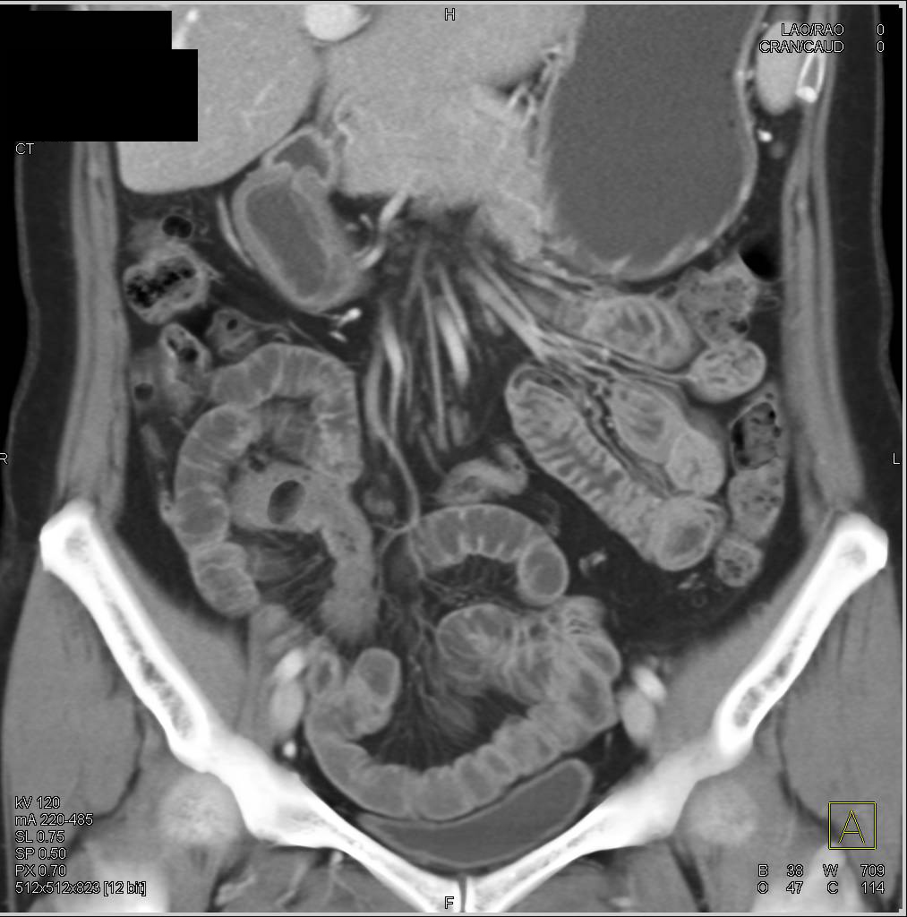 Mesenchymal Tumor off the Liver - CTisus CT Scan