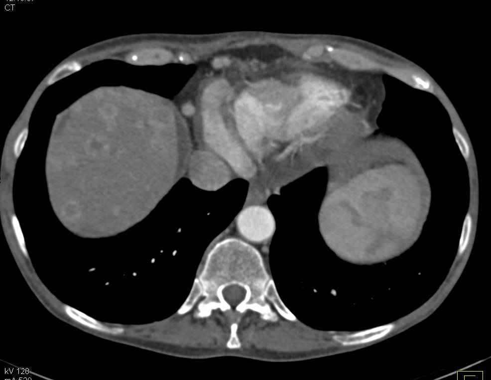 Metastatic Neuroendocrine Tumor - CTisus CT Scan