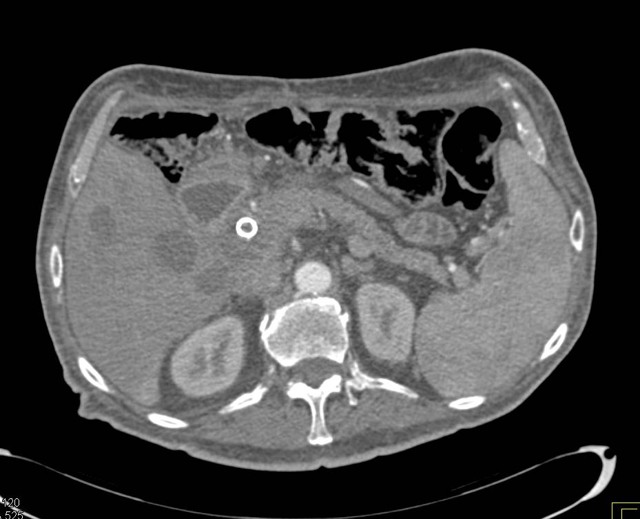 Invasive Pancreatic Cancer with Liver Abscess - CTisus CT Scan