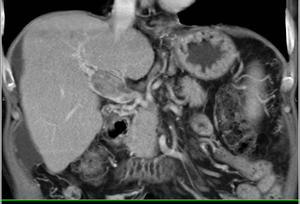 Hepatocellular Carcinoma (Hepatoma) with Portal Vein Involvement - CTisus CT Scan