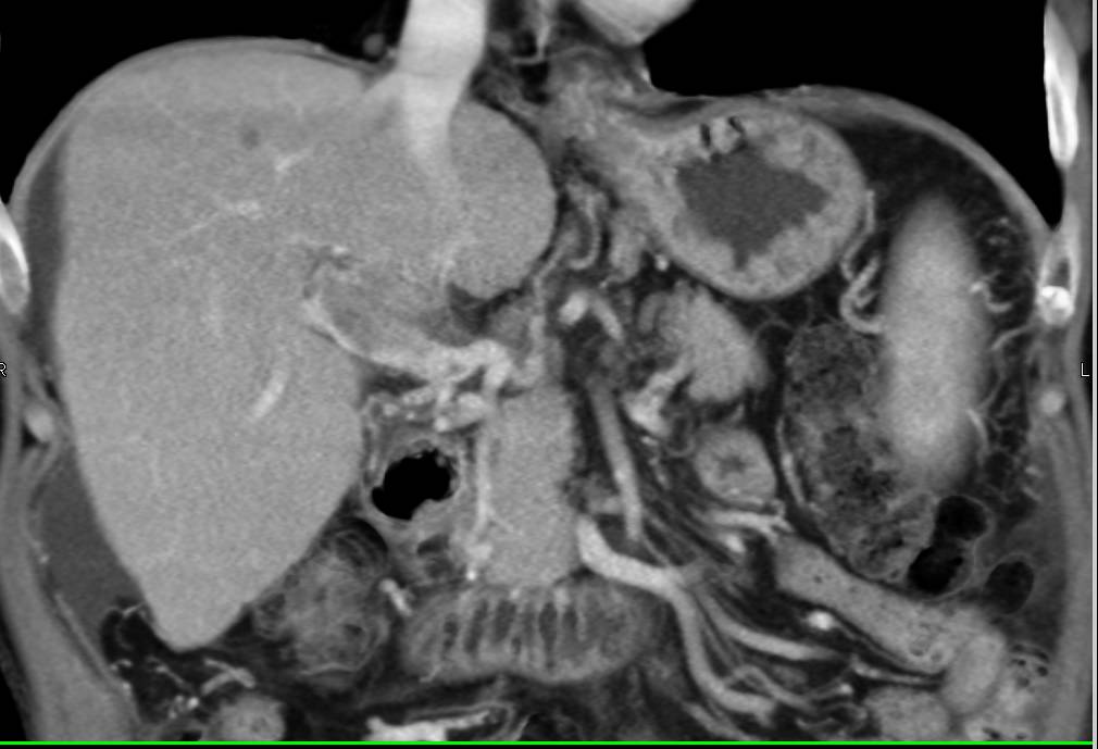 Portal Vein Invasion with Cavernous Transformation of the Portal Vein (CTPV) due to Hepatocellular Carcinoma (Hepatoma) - CTisus CT Scan