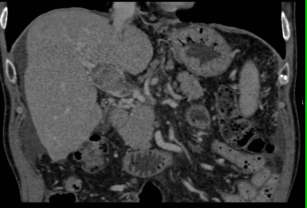 Cholangiocarcinoma Invades the Portal Vein with Collaterals - CTisus CT Scan