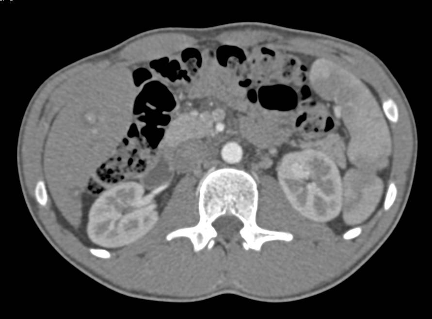 Vascular Metastases to the Liver - CTisus CT Scan