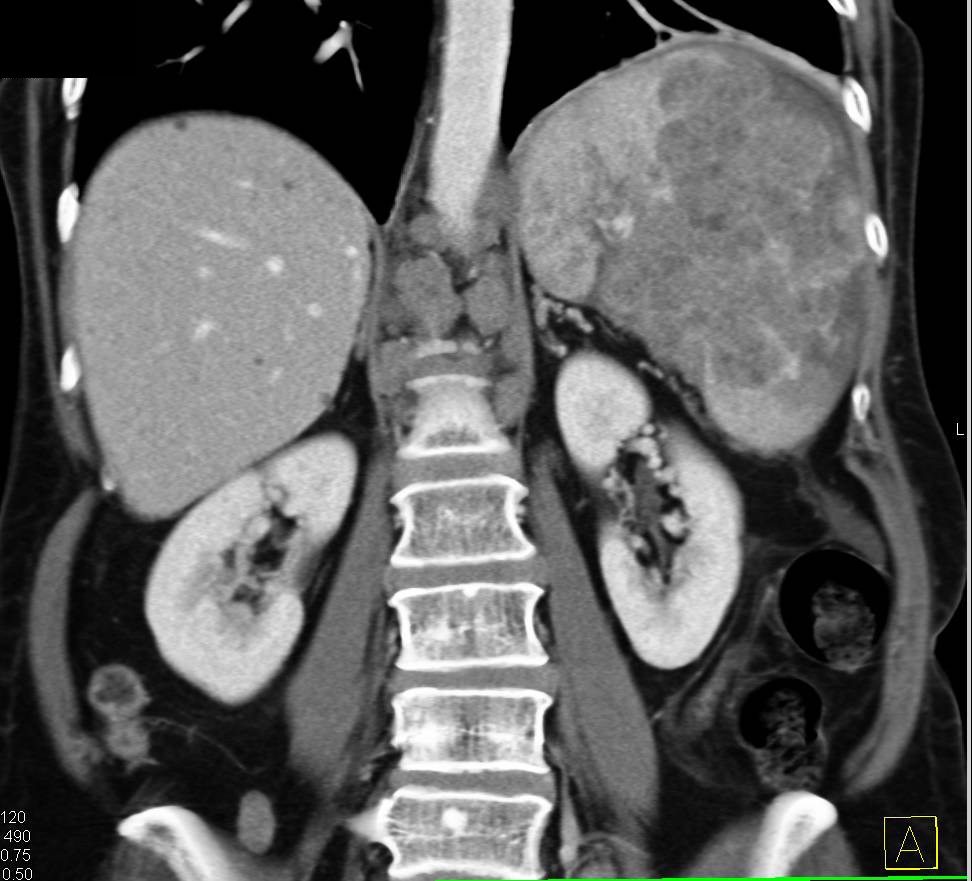 Lymphoma with Adenopathy and Liver and Splenic Involvement - CTisus CT Scan