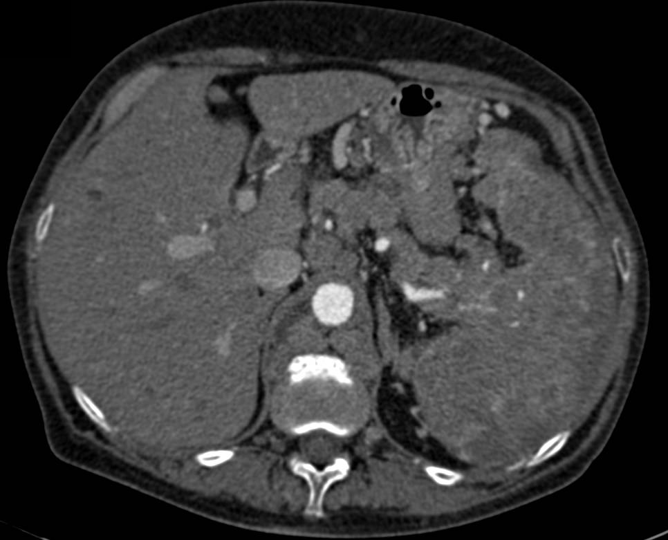 Lymphoma With Adenopathy And Liver And Splenic Involvement Liver Case