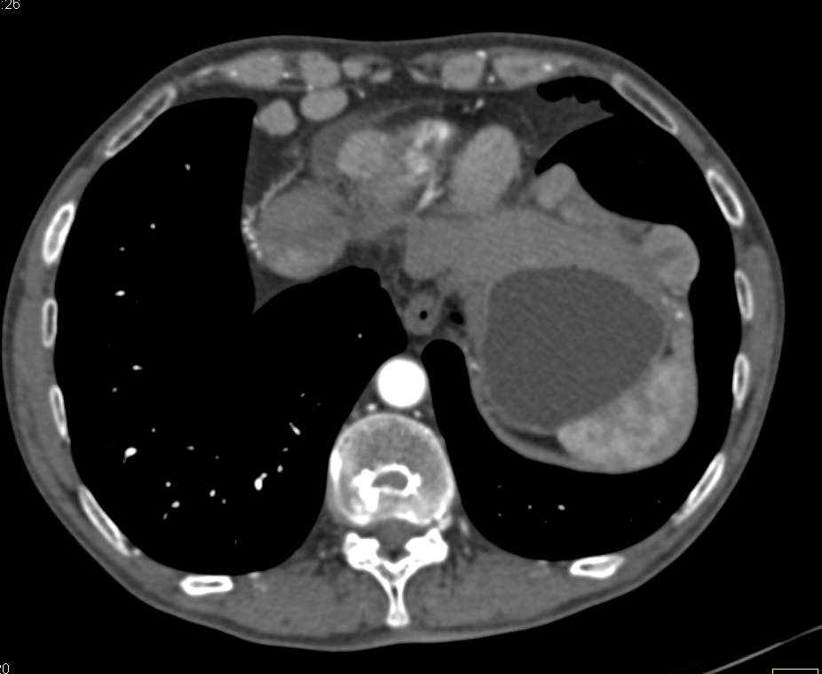 Metastatic Carcinoid Tumor with Implants on Liver - CTisus CT Scan