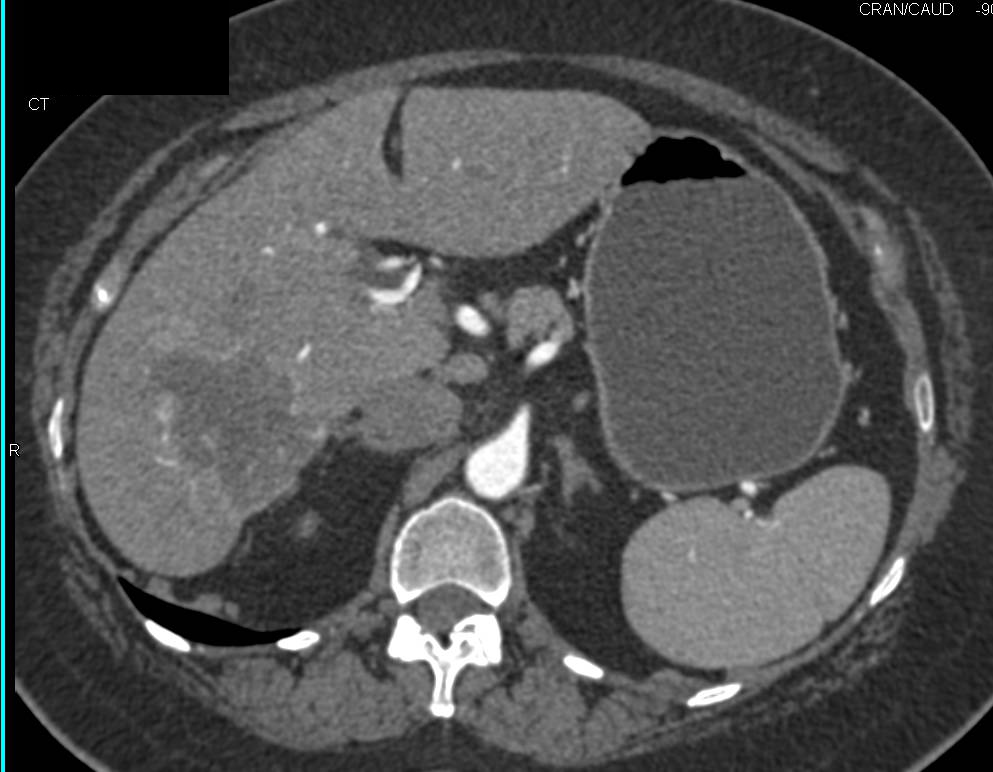 Liver Metastases Which Looks Almost Like Hemangioma on Early Phase Images - CTisus CT Scan