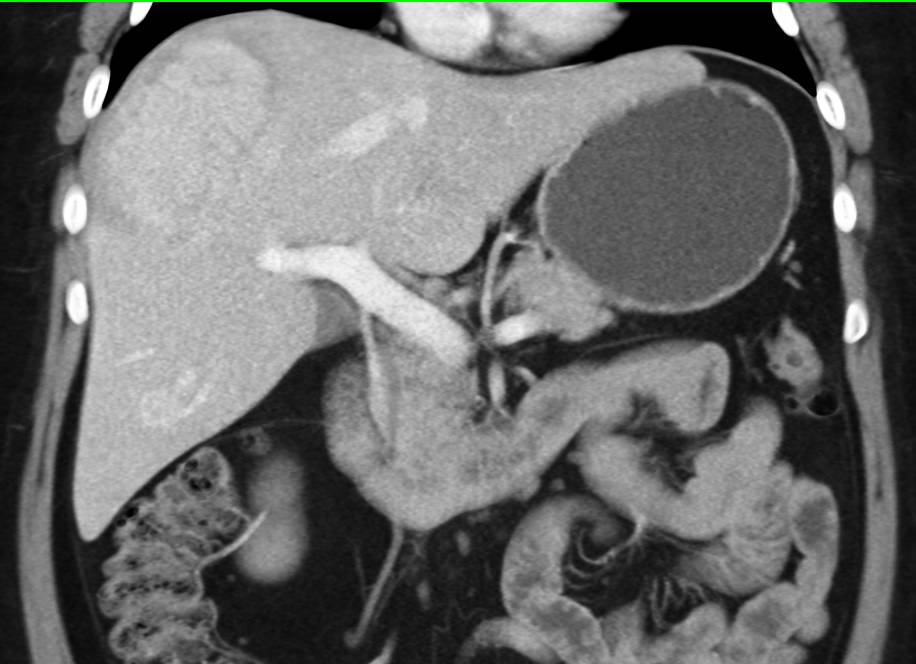 Hepatocellular Carcinoma (Hepatoma) Arising in a Cirrhotic Liver - CTisus CT Scan