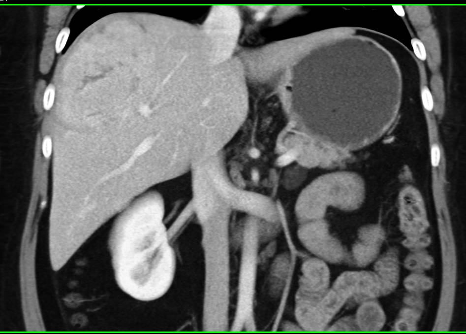 Hepatocellular Carcinoma (Hepatoma) with Neovascularity - CTisus CT Scan