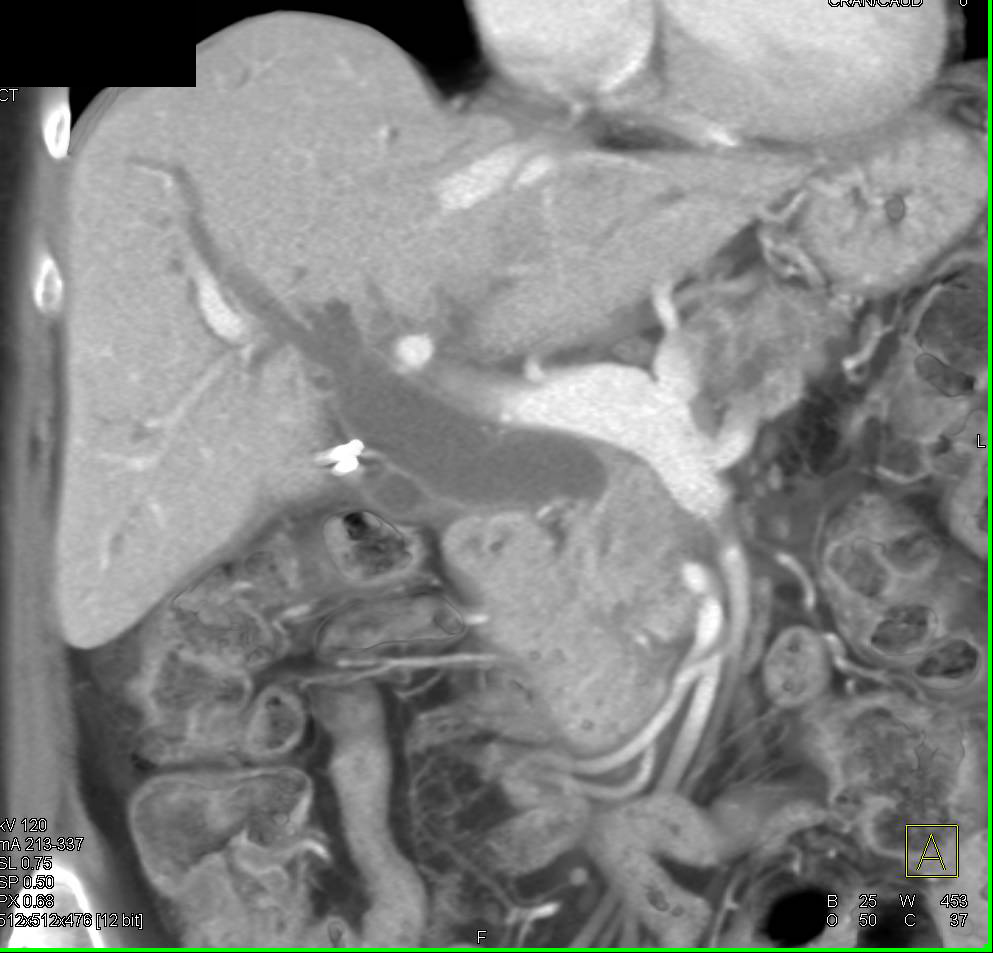 Ampullary Cancer with Dilated Common Bile Duct (CBD) - CTisus CT Scan