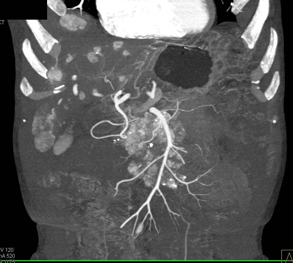 Vascular Neuroendocrine Tumor with Liver Metastases - CTisus CT Scan