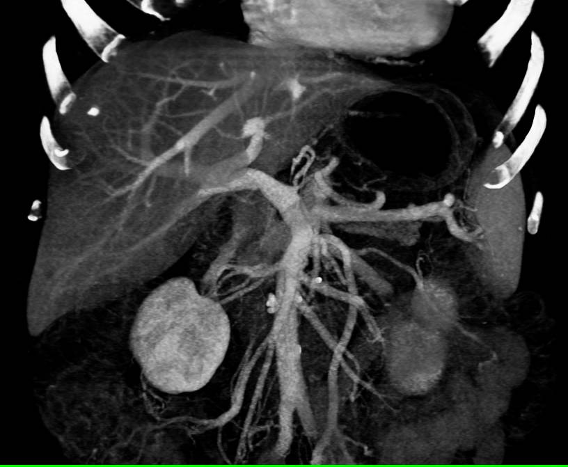 Mild Perfusion Changes in the Liver - CTisus CT Scan