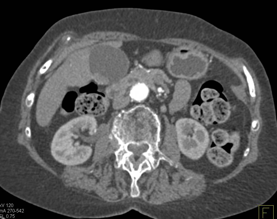 Polypoid Lesion in the Gallbladder - CTisus CT Scan