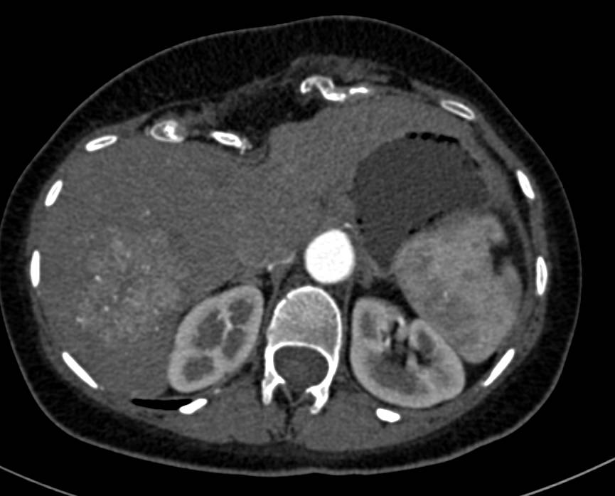 Incidental Focal Nodular Hyperplasia (FNH) in Patient with Aortic Dissection - CTisus CT Scan