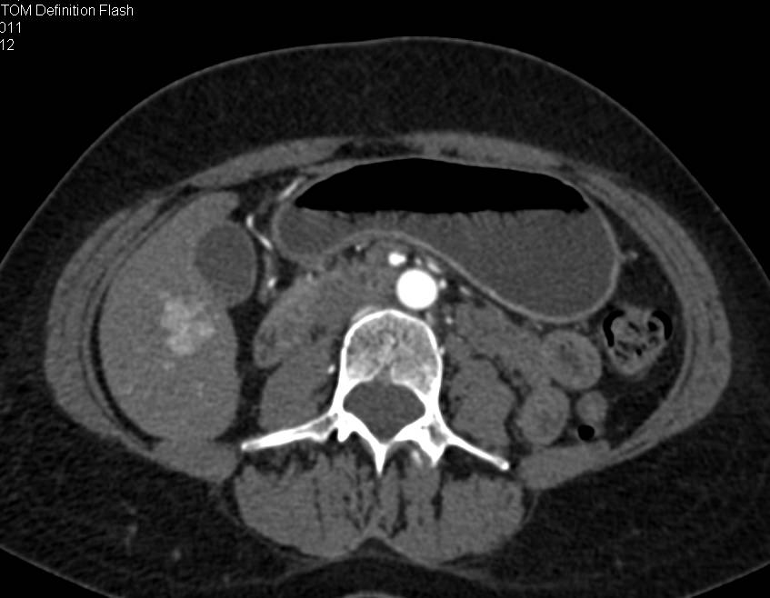 Multiple Focal Nodular Hyperplasias (FNHs) in the Liver - CTisus CT Scan