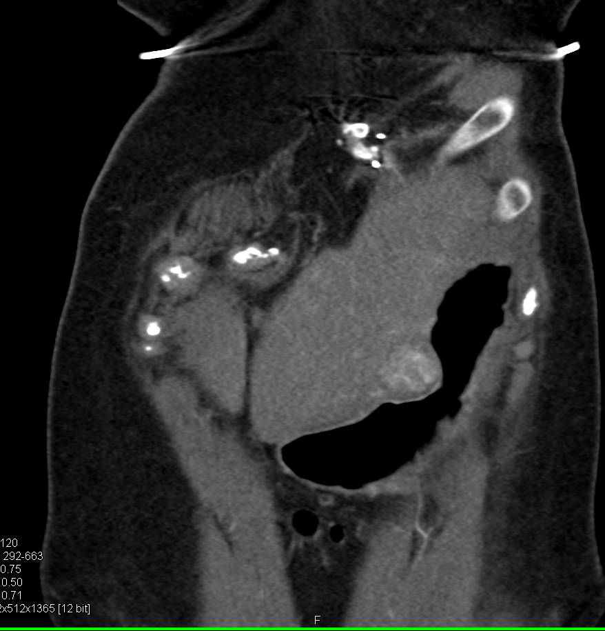 Multiple Focal Nodular Hyperplasias (FNHs) - CTisus CT Scan