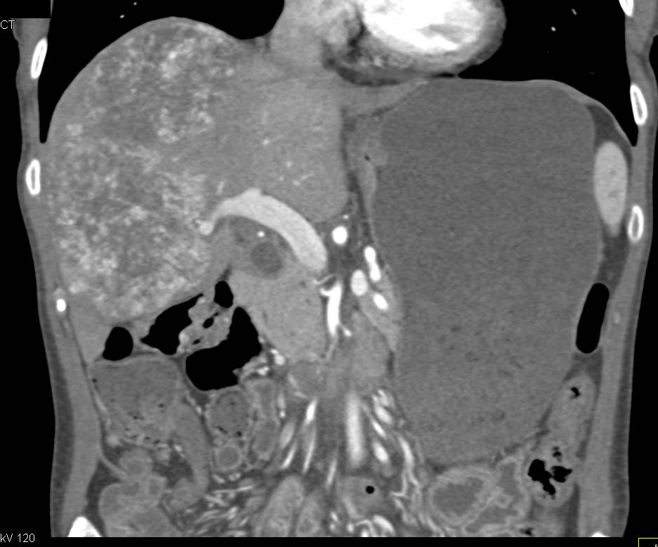 Angiosarcoma of the Liver - CTisus CT Scan