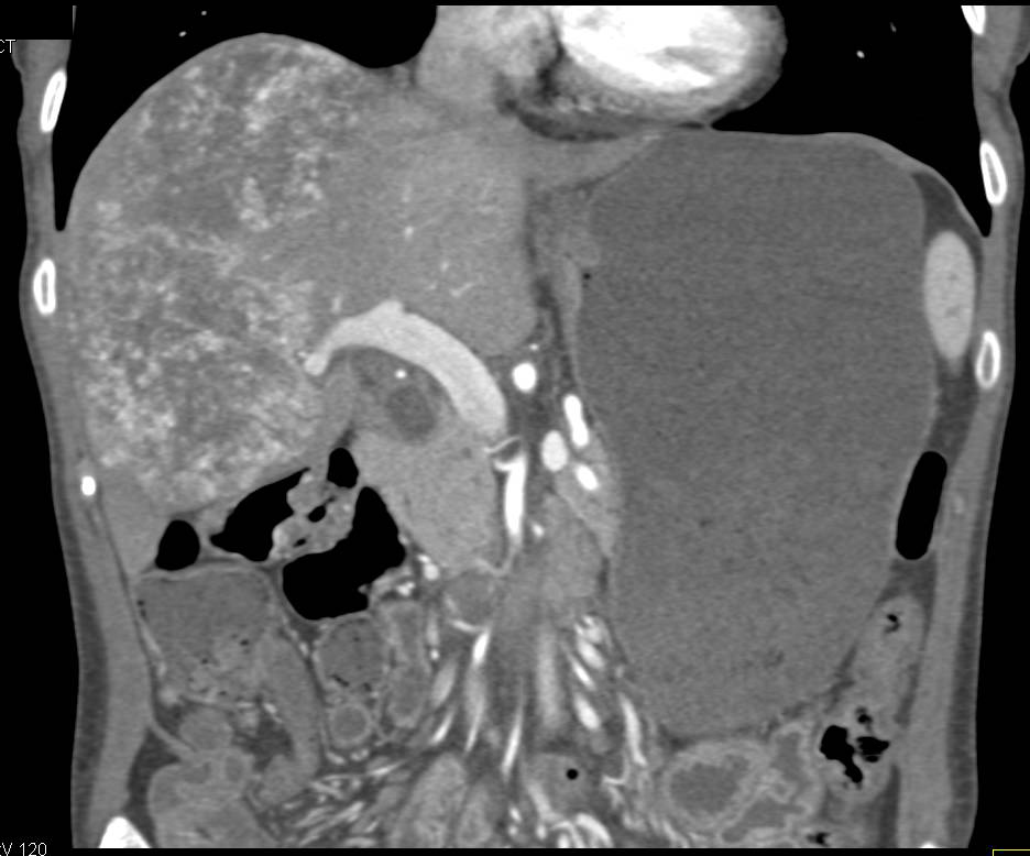 Angiosarcoma of the Liver - CTisus CT Scan