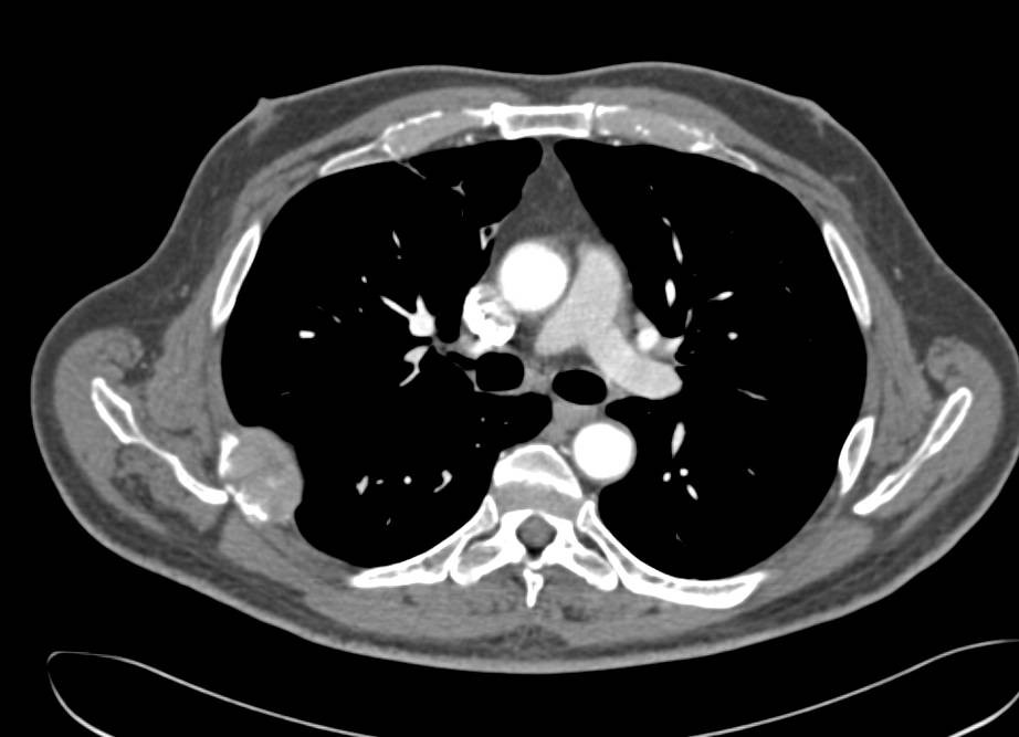 Metastatic Neuroendocrine Tumor with Liver and Bone Lesions - CTisus CT Scan