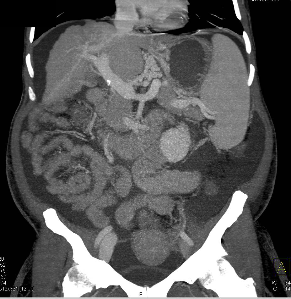 Cirrhosis with Portal Hypertension and Recanalization of the Umbilical Vein - CTisus CT Scan