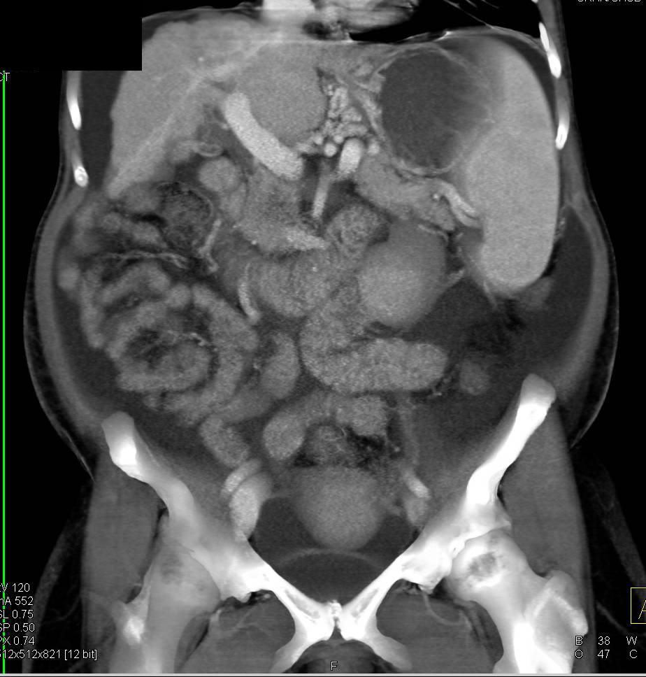 Cirrhosis With Portal Hypertension And Recanalization Of The Umbilical 