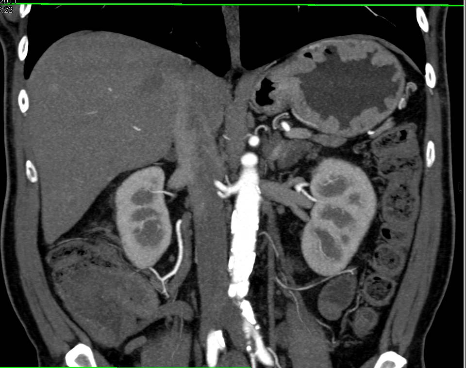 Vascular Metastases to the Liver Only Seen on the MIP Images - CTisus CT Scan