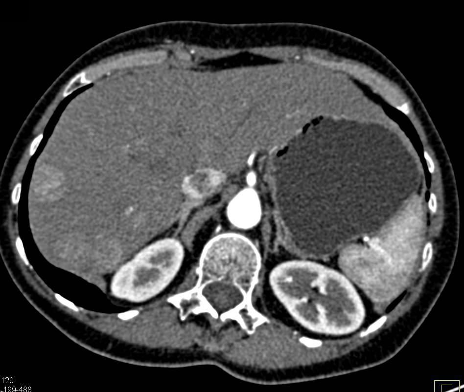 Metastatic Carcinoid Tumor to the Liver - CTisus CT Scan