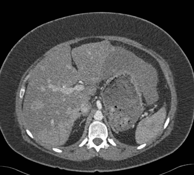 Multifocal Hepatocellular Carcinoma (Hepatoma) - CTisus CT Scan