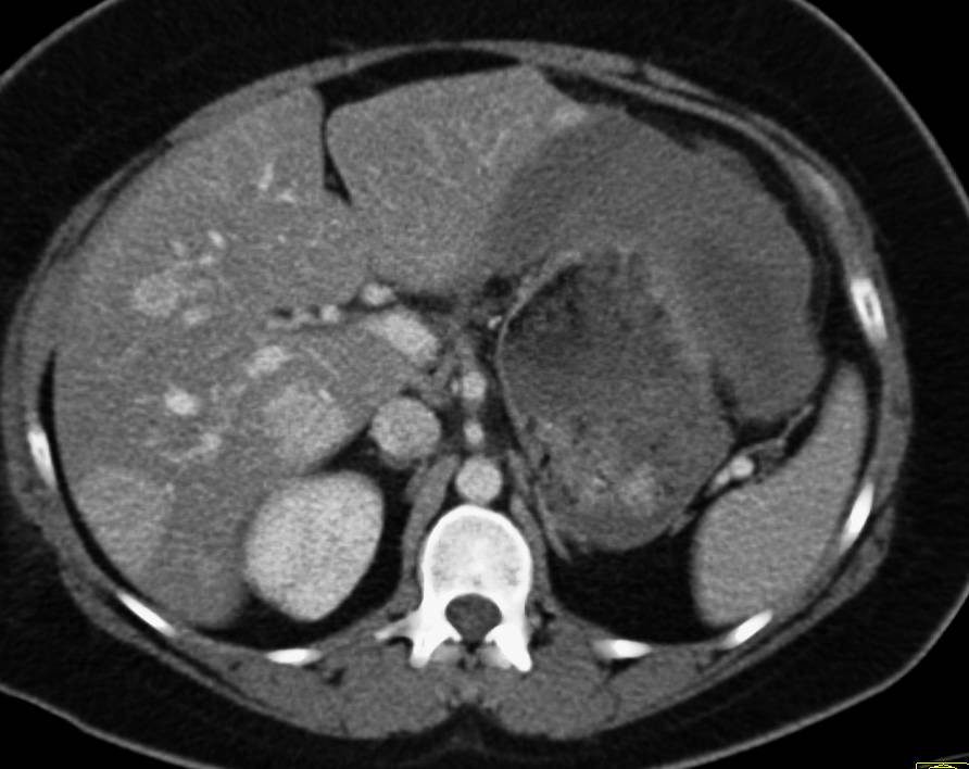 Multifocal Liver Disease with Biopsy Proven Hepatocellular Carcinoma ...