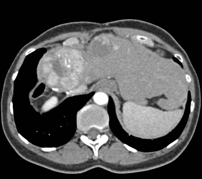Recurrent Hepatocellular Carcinoma (Hepatoma) - CTisus CT Scan