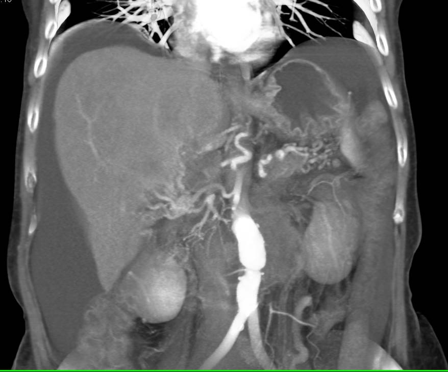 Intrahepatic Cholangiocarcinoma with Portal Vein (PV) Encasement and Cavernous Transformation of the Portal Vein (CTPV) - CTisus CT Scan