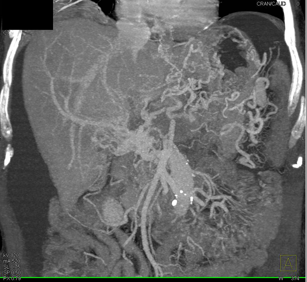 Hepatocellular Carcinoma (Hepatoma) in Cirrhotic Liver with Vessel Encasement Including Inferior Vena Cava (IVC) Involvement - CTisus CT Scan