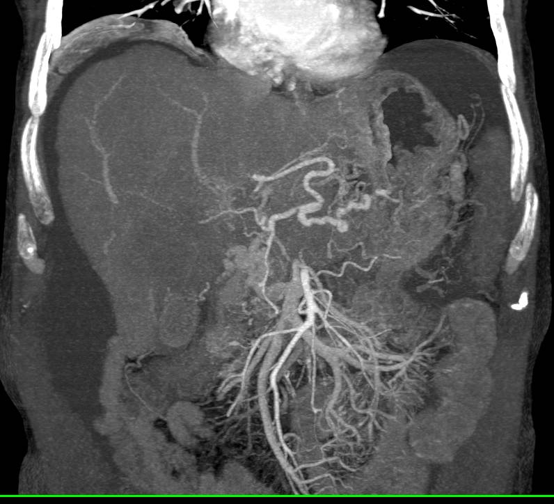 Hepatocellular Carcinoma (Hepatoma) (HCC) Arises in a Cirrhotic Liver with Vessel Encasement - CTisus CT Scan