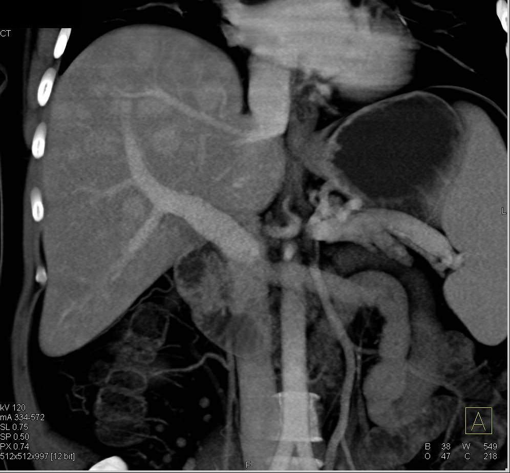 Vascular Liver Metastases - CTisus CT Scan