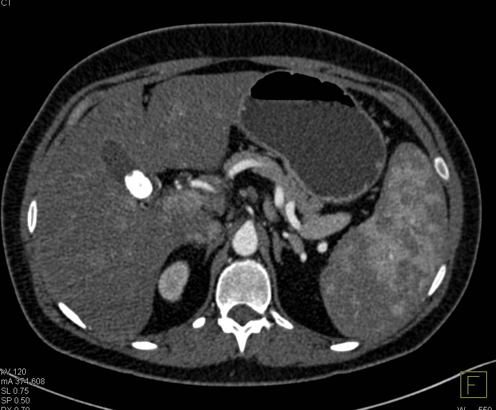 Vascular Liver Metastases Liver Case Studies Ctisus Ct Scanning