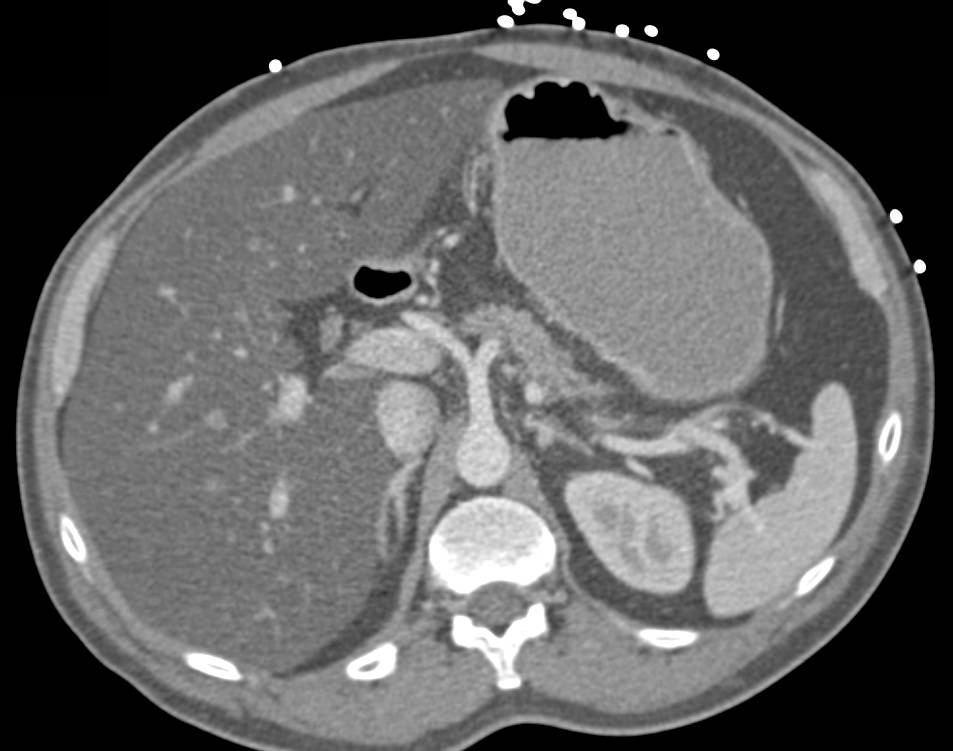 Excellent Classic Example of Fatty Liver - CTisus CT Scan