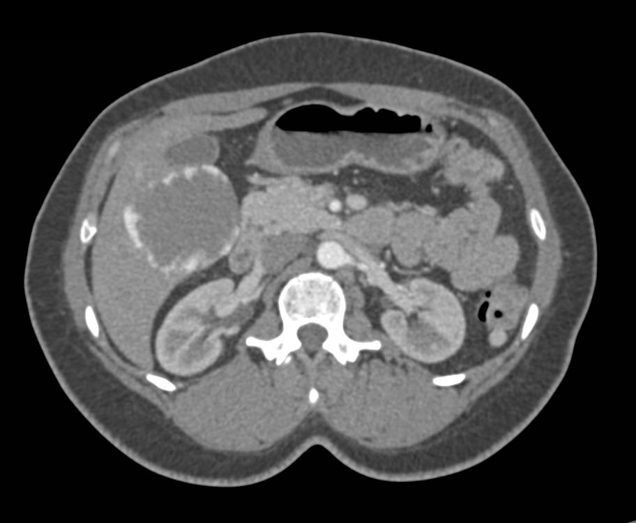 Giant Cavernous Hemangioma of the Liver with Multiple Phases - CTisus CT Scan