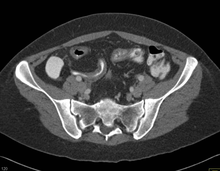 Classic Crohn's Disease with Small bowel Halo, Fibrofatty Infiltration of the Mesentery and Prominent Vasa Recta - CTisus CT Scan