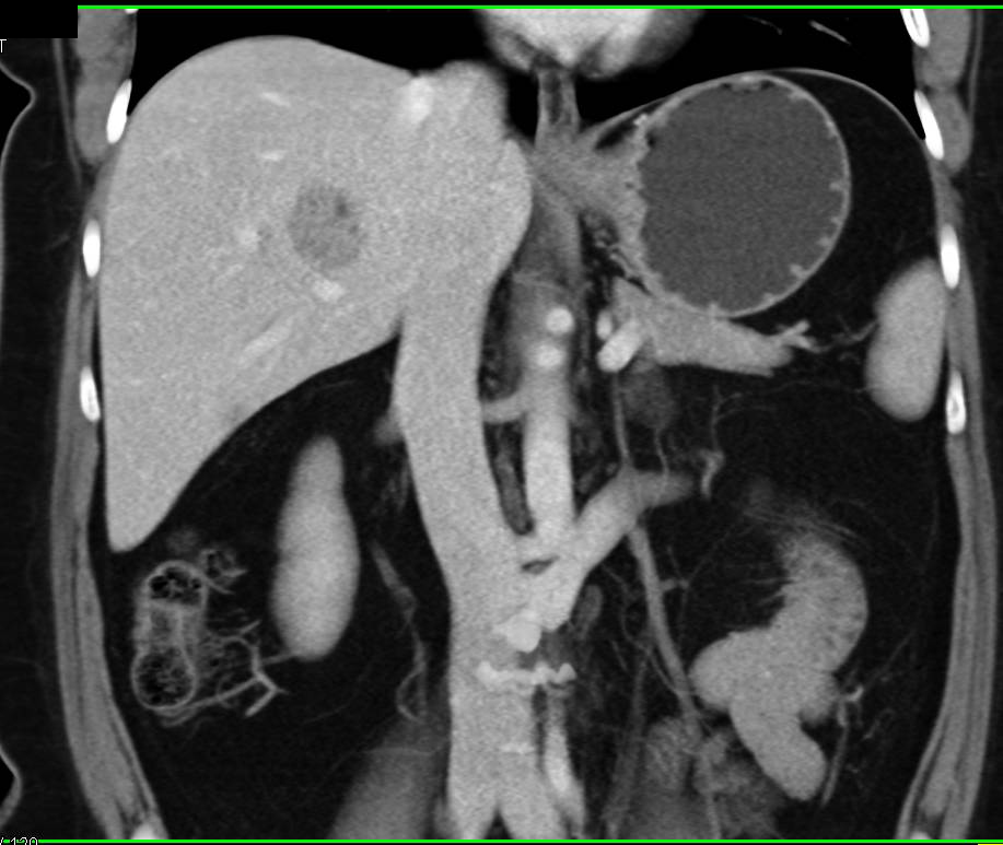 Atypical Hemangioma looks like Liver Metastasis - CTisus CT Scan