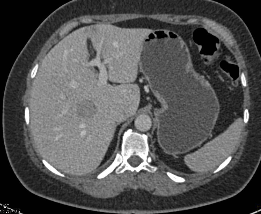 Atypical Hemangioma looks like Liver Metastasis - Liver Case Studies